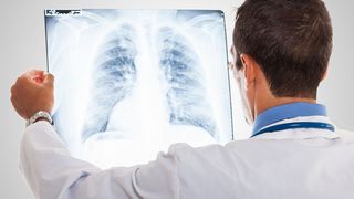 COPD - Lungenemphysem Arzt schaut auf Röntgenbild der Lunge