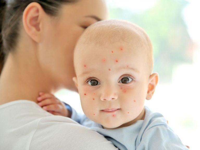 Mutter mit einem Kind, das an Röteln erkrankt ist