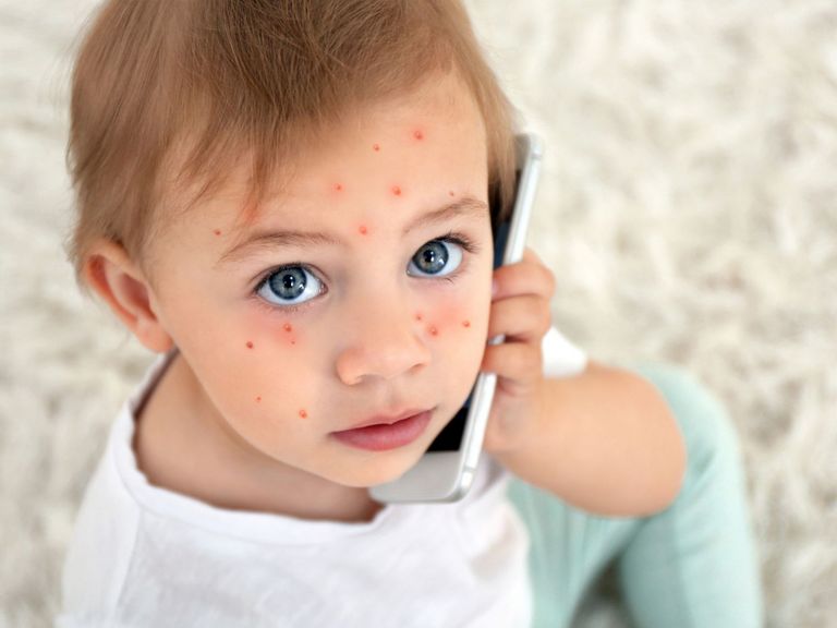 Kleinkind mit Windpocken im Gesicht