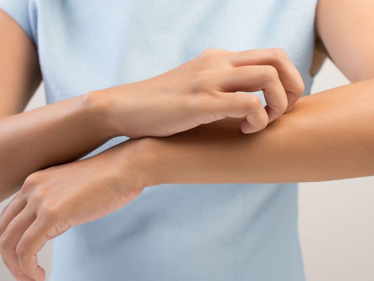 Frau kratzt sich aufgrund eines Mückenstichs am Arm