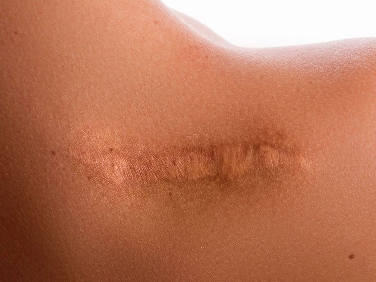 Schulter mit einer Narbe